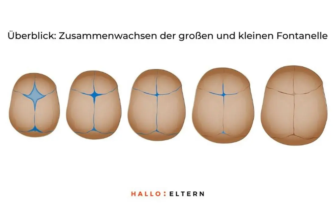 fontanelle eingefallen - Wie sollte sich Fontanelle anfühlen
