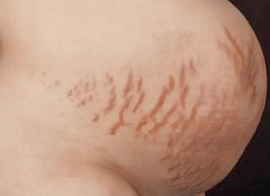 hautveränderung schwangerschaft - Wie verändert sich die Haut wenn man schwanger ist