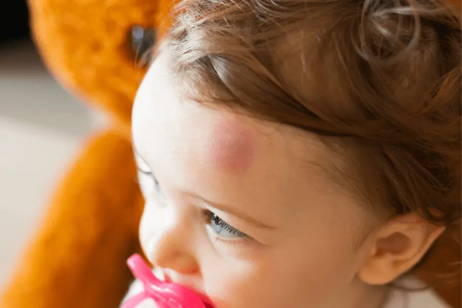 anzeichen gehirnerschuetterung symptome baby - Wie verhält sich ein Baby mit Gehirnerschütterung