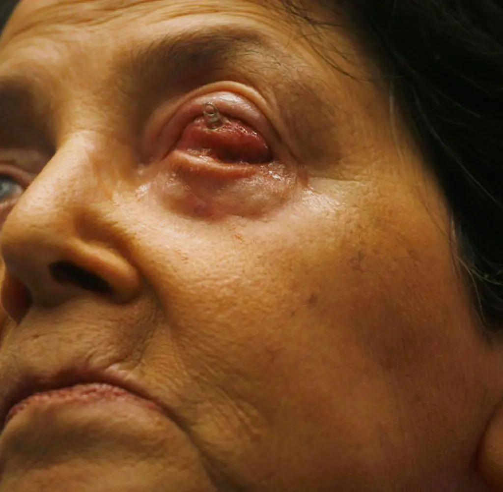 wie sieht ein blindes auge aus - Wie viel sieht man wenn man blind ist