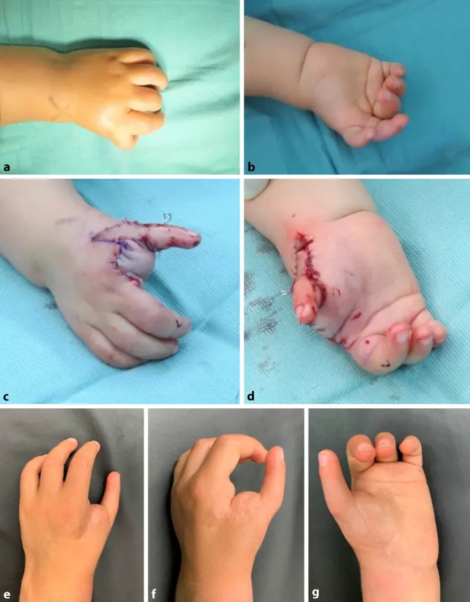 fehlende hand bei geburt - Wie viele Kinder kommen mit Fehlbildungen zur Welt
