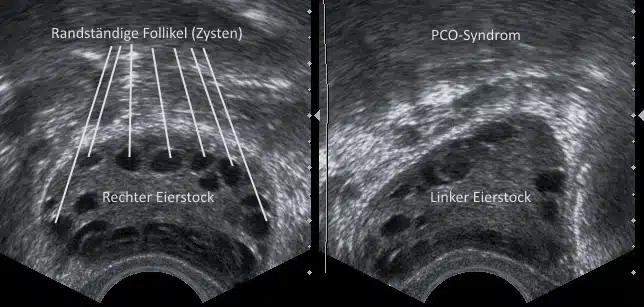 pco syndrom schwangerschaft - Wie wahrscheinlich ist es mit PCO schwanger zu werden