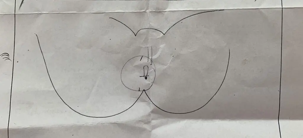 mariske nach geburt - Wie werde ich Marisken los