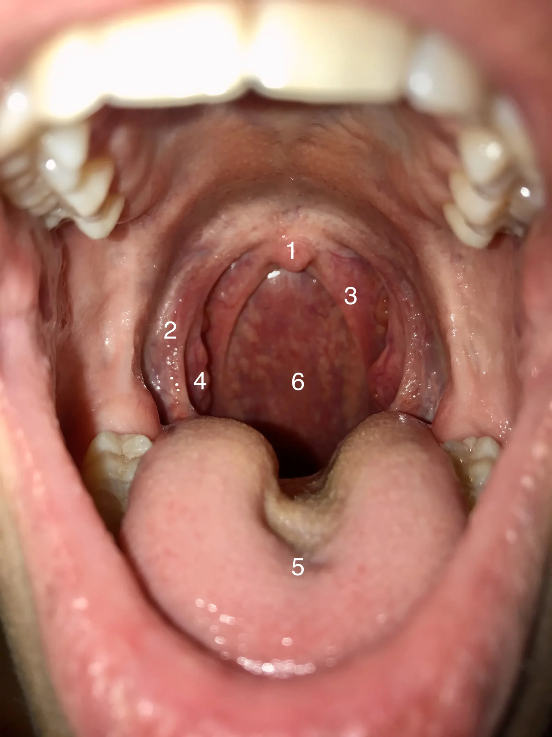 zu große mandeln - Wie werden Mandeln kleiner