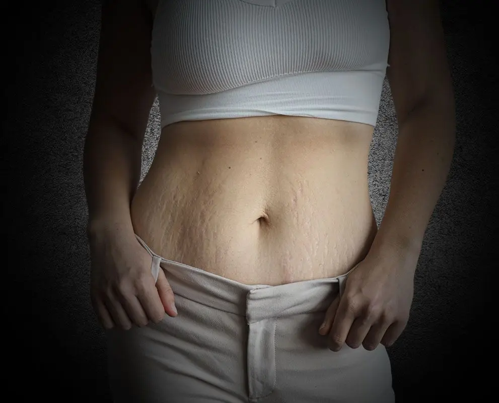 schlaffe haut am bauch nach geburt - Wie wird die Haut am Bauch wieder straff nach Schwangerschaft