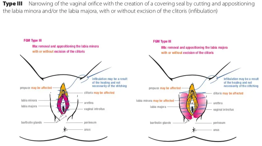 fgm geburt - Wie wird die Klitoris entfernt