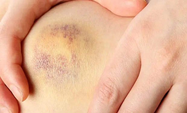 Hämatom nach Geburt: Wie lange dauert es und was kann man tun? - Wie wird ein Hämatom ausgeräumt hämatom nach geburt wie lange - Wie wird ein Hämatom ausgeräumt