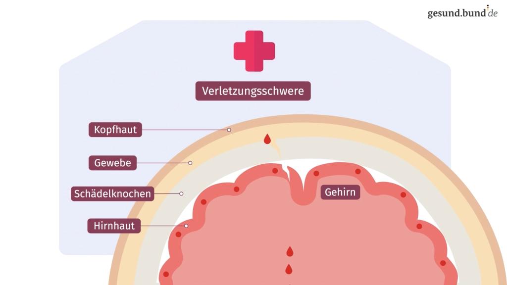 was tun bei einer leichten gehirnerschütterung - Wie wird eine leichte Gehirnerschütterung behandelt