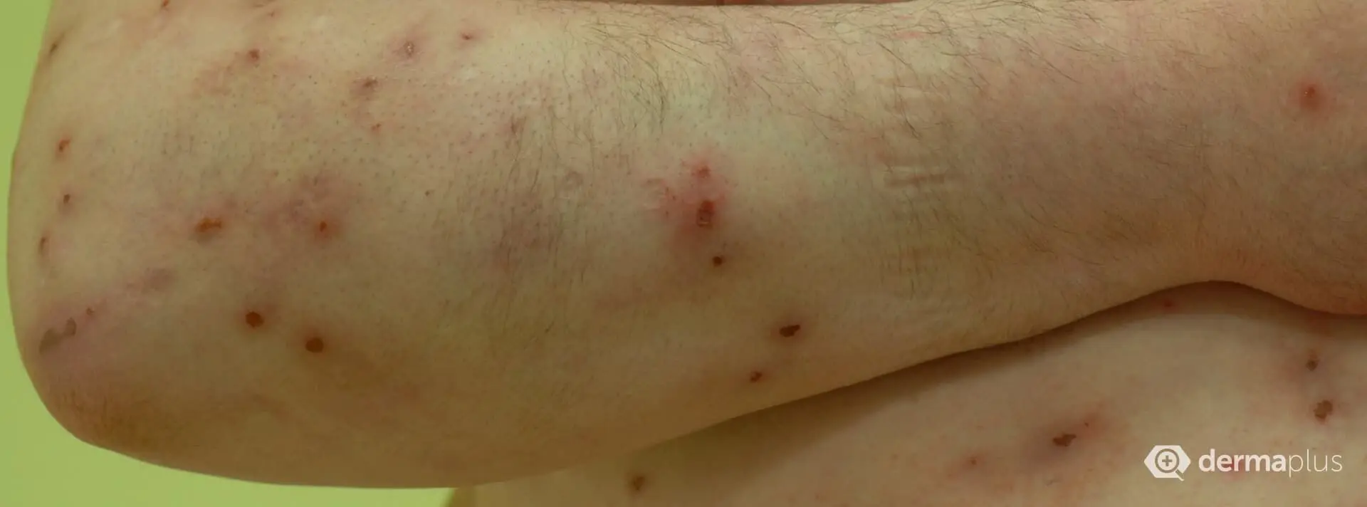 Juckreiz durch hormonelle Veränderungen: Ursachen, Symptome und Behandlung - Wie wirkt sich Östrogenmangel auf die Haut aus juckreiz durch hormonelle veränderungen - Wie wirkt sich Östrogenmangel auf die Haut aus