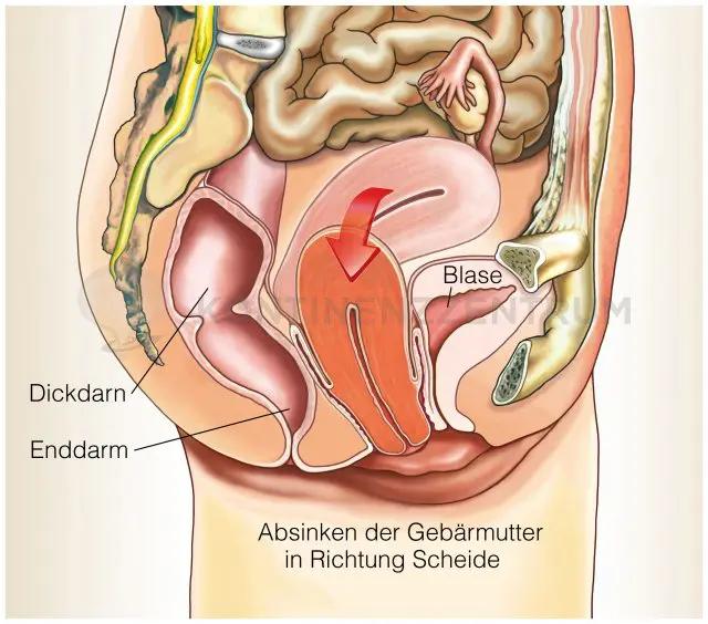 Gebärmuttersenkung: Bilder, Symptome und Behandlung - Wie zeigt sich eine Gebärmuttersenkung gebärmuttersenkung bilder - Wie zeigt sich eine Gebärmuttersenkung