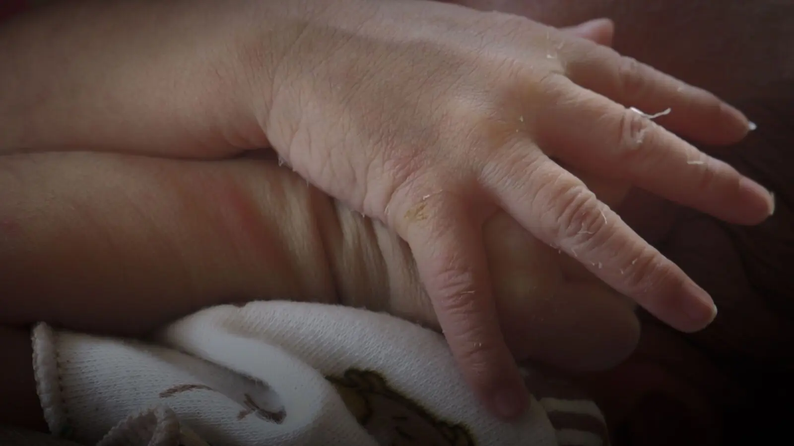 Faltige Hände nach der Geburt: Ursachen, Behandlung und Vorbeugung - Wieso habe ich so faltige Hände faltige hände seit geburt - Wieso habe ich so faltige Hände