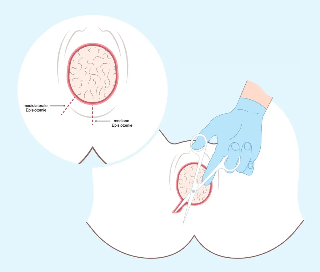 dammschnitt geburt - Wird bei jeder Geburt ein Dammschnitt gemacht