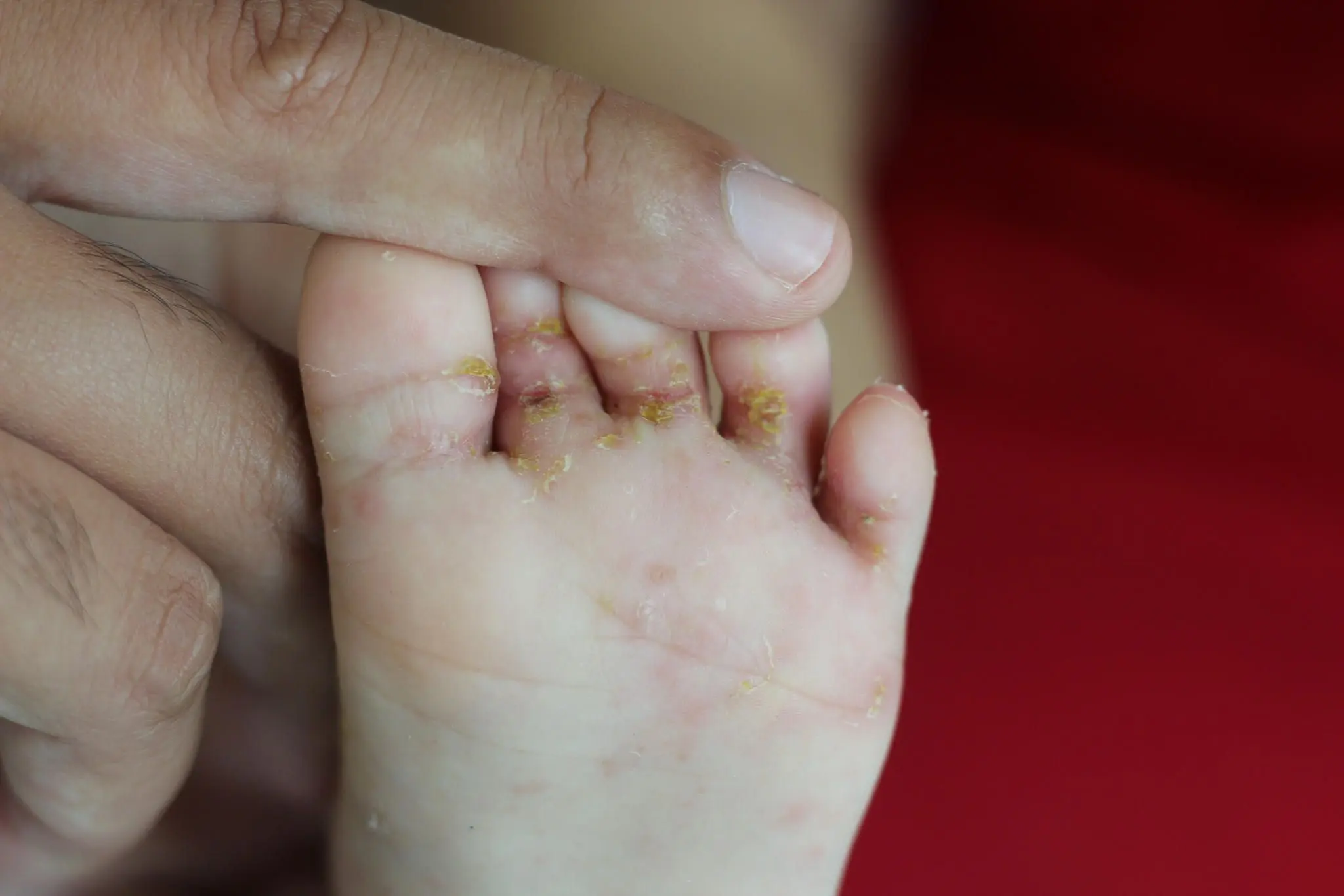 krätze bei kindern bilder - Wo bricht Krätze zuerst aus