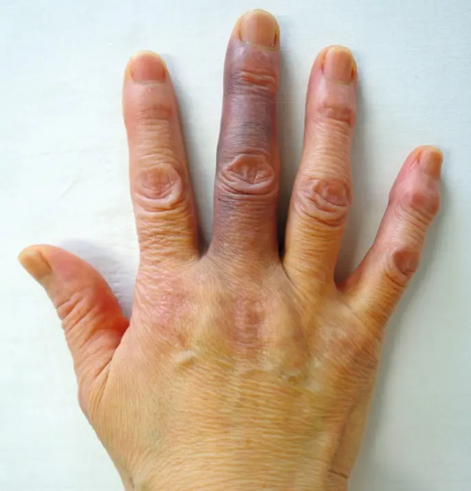 blaues fingergelenk - Woher kommt das Achenbach-Syndrom