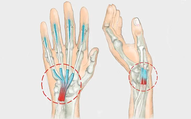 sehnenscheidenentzündung schwangerschaft - Woher weiß ich ob ich eine Sehnenscheidenentzündung