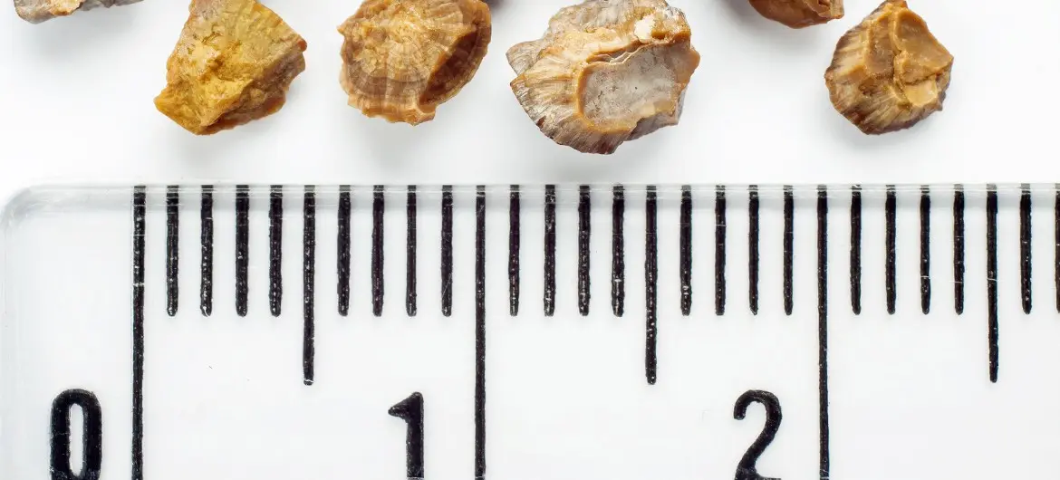 nierensteine nach geburt - Woher weiß ich ob ich Nierensteine habe