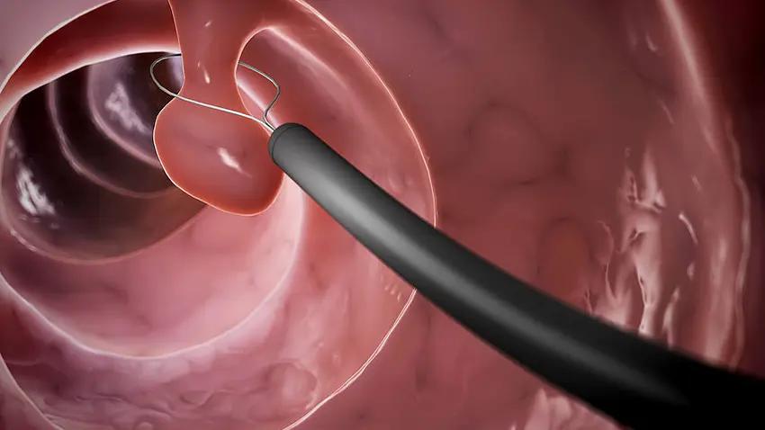 polypen nase aussehen - Woher weiß man dass man Polypen hat