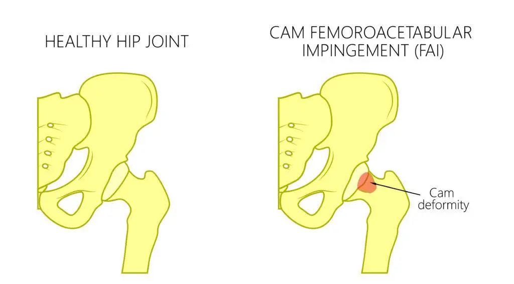 Hüftblockade Symptome: Ursachen, Diagnose und Behandlung - Wohin strahlen Schmerzen in der Hüfte aus hüftblockade symptome - Wohin strahlen Schmerzen in der Hüfte aus